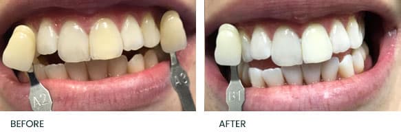 Teeth Whitening Before After 2