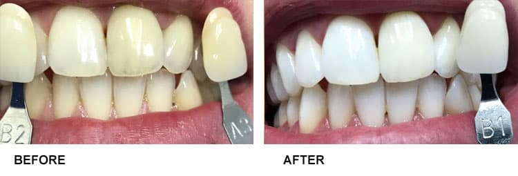 Teeth Whitening Before After 4