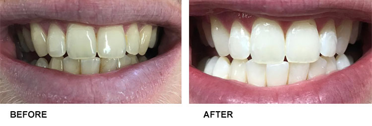 Teeth Whitening Before After 11