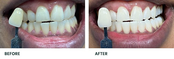 Teeth Whitening Before After 13