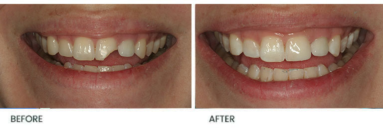 Bonding Before After 1 - Wimpole Dental Office