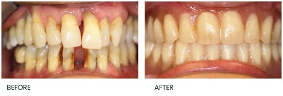 Upper and Lower full arch implant reconstruction