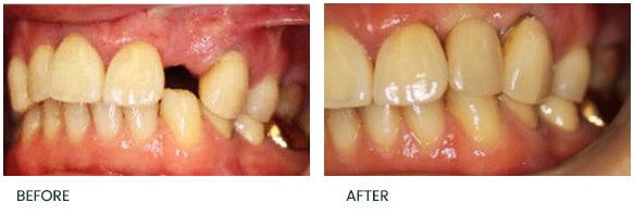 Delayed replacement of a upper left lateral incisor