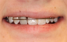 Adolescent female teeth 1