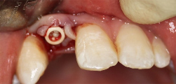 Adolescent female teeth 13