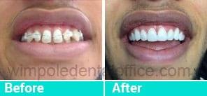 Smile gallery before after