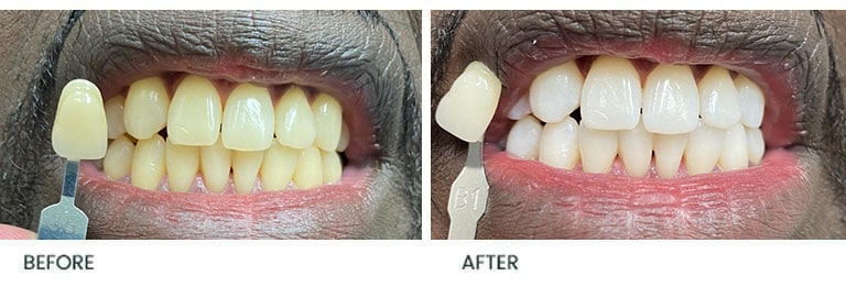Teeth Whitening Before After 16 - Wimpole Dental Office