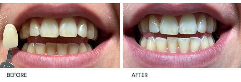 Teeth Whitening Before After 7 - Wimpole Dental Office