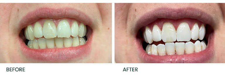 Teeth Whitening Before After 9 - Wimpole Dental Office