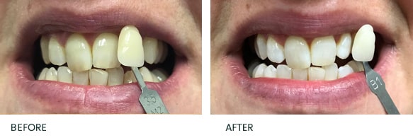 Teeth Whitening