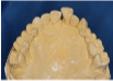 Lower denture a