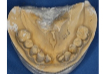 Lower denture b