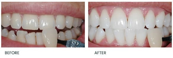 Teeth Whitening Treatment