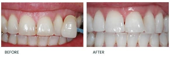 Teeth Whitening Treatment