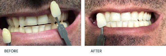 Teeth Whitening Before After 1