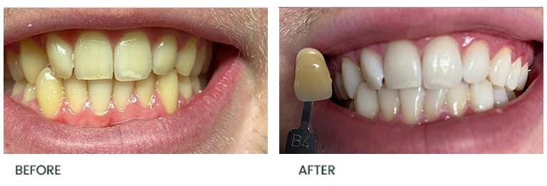 Teeth Whitening Treatment