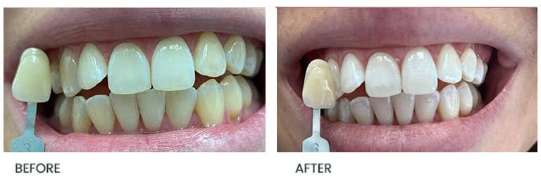 Teeth Whitening Before After 29