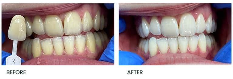 Teeth Whitening Before After 30