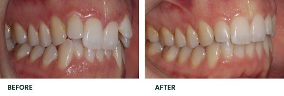 Teeth Whitening Before After 14