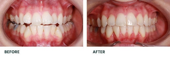 Teeth Whitening Before After 14