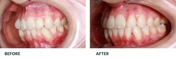 Teeth Whitening Before After 14