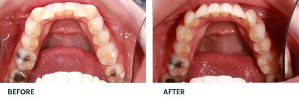 Teeth Whitening Before After 14