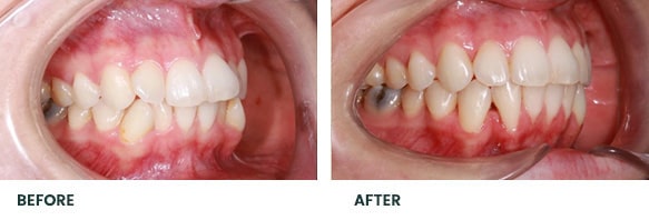 Teeth Whitening Before After 14