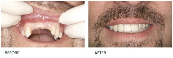 Front teeth dental implants