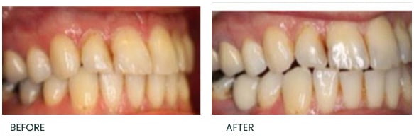 Delayed replacement of a lower right 2nd premolar tooth