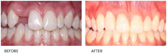 Single implant to replace congenitally absent UR2