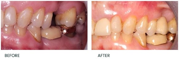 Single implant to replace missing UL6