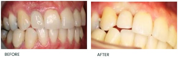 Failed UR lateral apicoectomy with an immediate implant