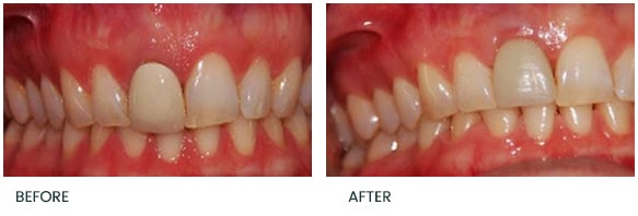 Immediate replacement of failing UR1