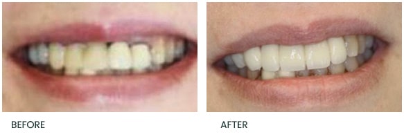 Failed anterior bridge