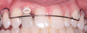 Adolescent female teeth 15