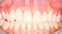 Adolescent female teeth 18