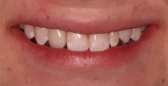 Adolescent female teeth 21