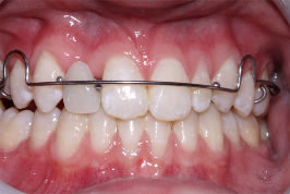 Adolescent female teeth 2
