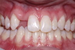 Adolescent female teeth 3