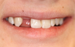 Adolescent female teeth 4