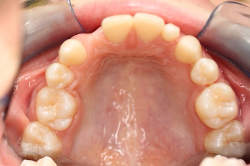 Adolescent female teeth 6