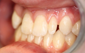 Adolescent female teeth 7