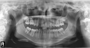 Adolescent female teeth 9