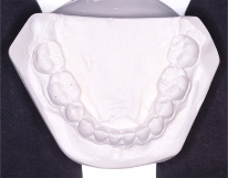 Adolescent female teeth 10