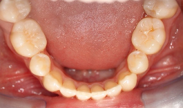 Adolescent female teeth 11