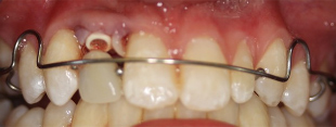Adolescent female teeth 14