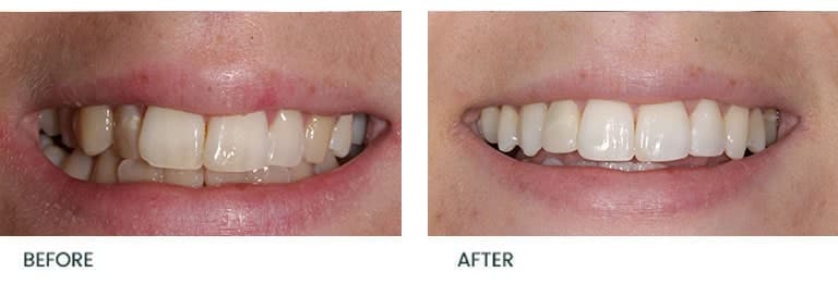 Invisalign Before After - Wimpole Dental Office
