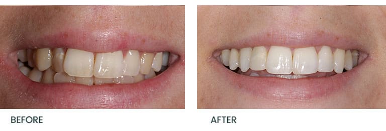 Invisalign Before After3 - Wimpole Dental Office