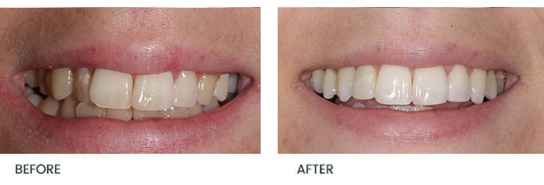 Invisalign Before After - Wimpole Dental Office