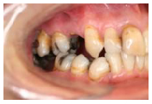 teeth fractured leaving space